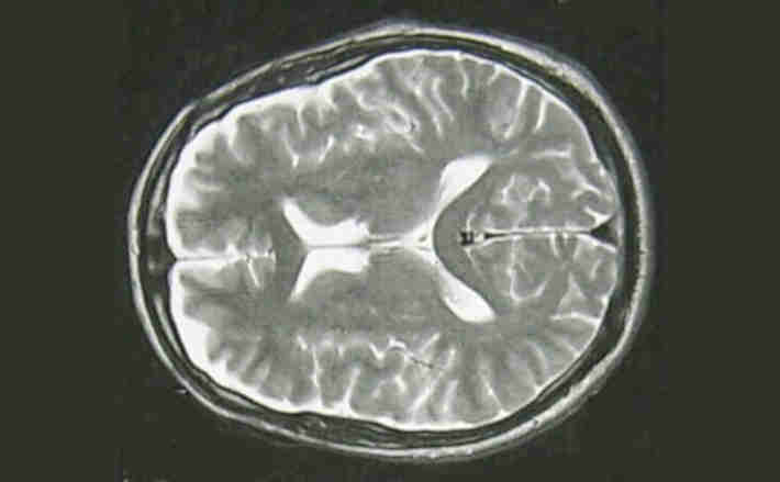 Scheibe eines MRT-Bildes vom menschlichen Gehirn