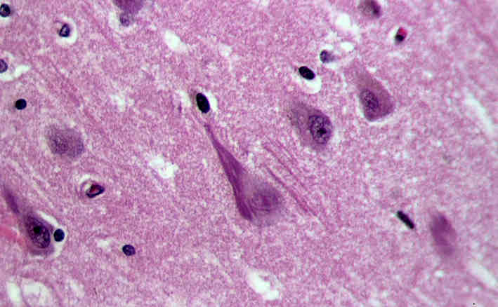Alzheimer-Fibrille im Hippocampus eines alten Menschen mit Alzheimer-Pathologie in der HE-Färbung. Von Patho - Eigenes Werk, Link, CC BY-SA 3.0
